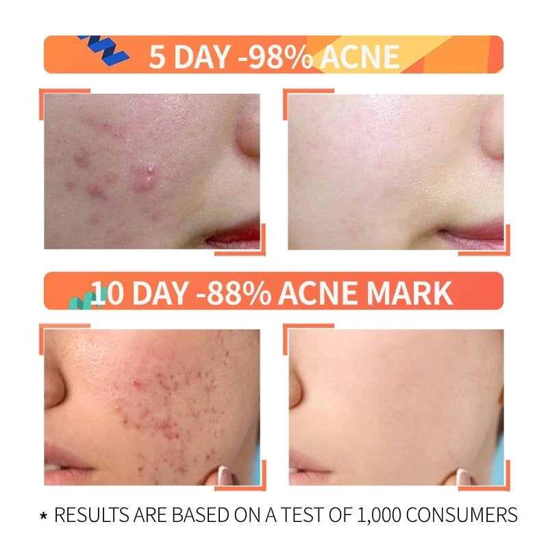 The Ordinary Niacinamide 10% + Zinc 1